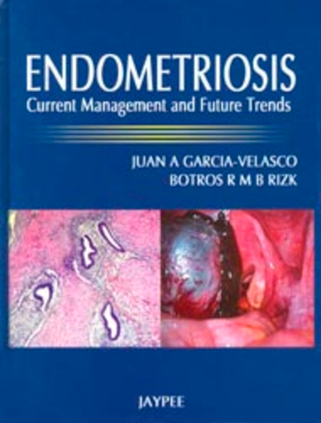 Cover image for Endometriosis ISBN 9788184488081