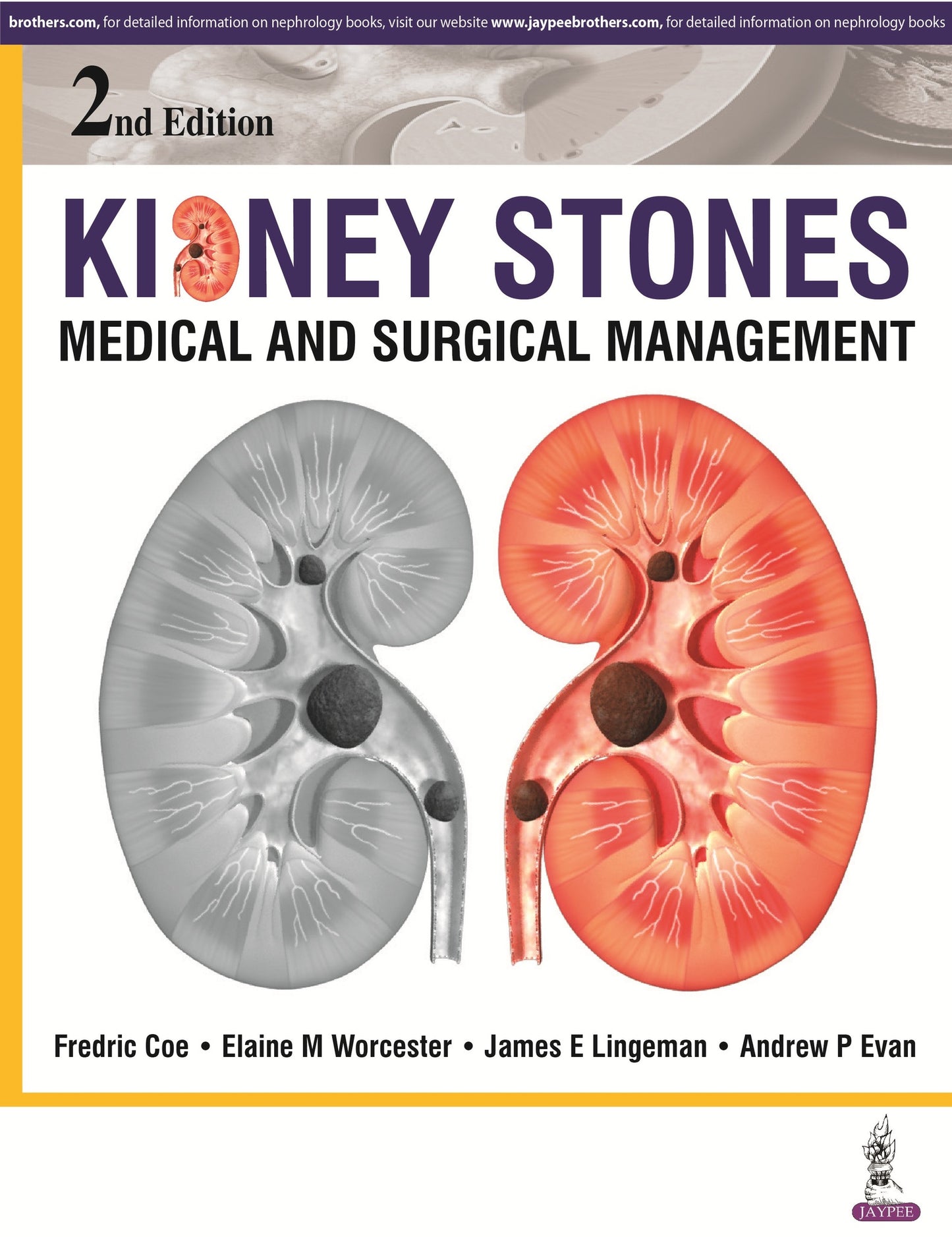 Kidney Stones