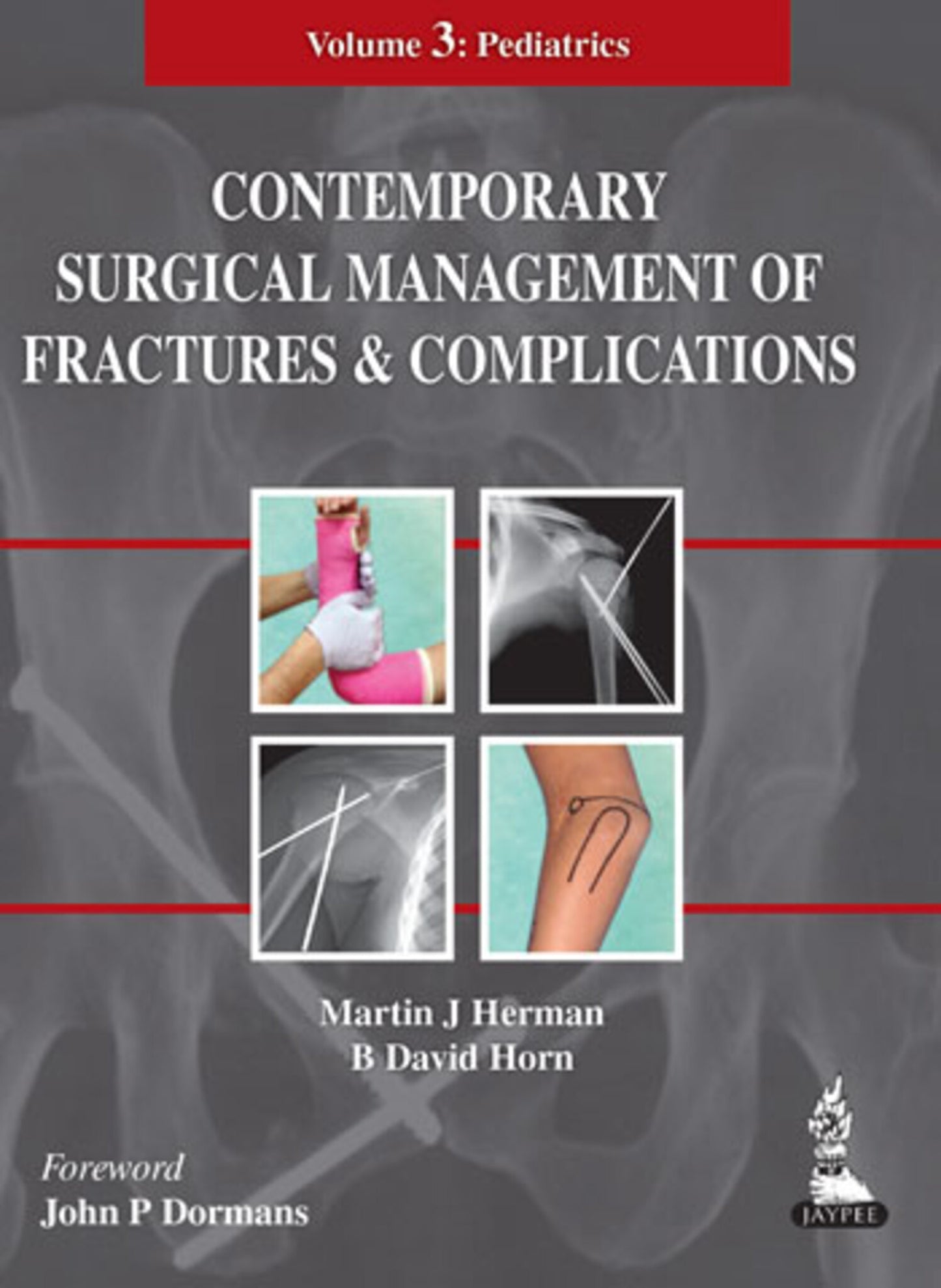 Contemporary Surgical Management of Fractures and Complications