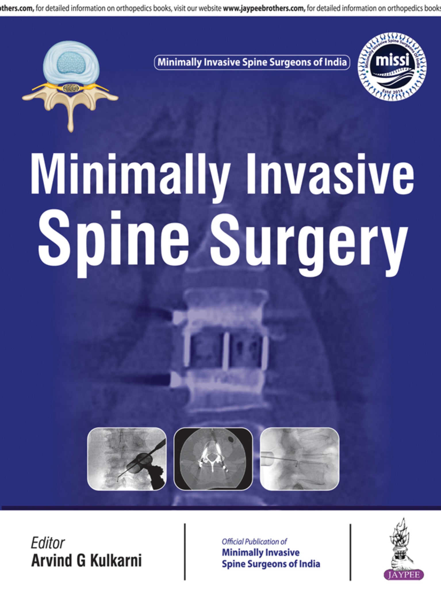 Minimally Invasive Spine Surgery