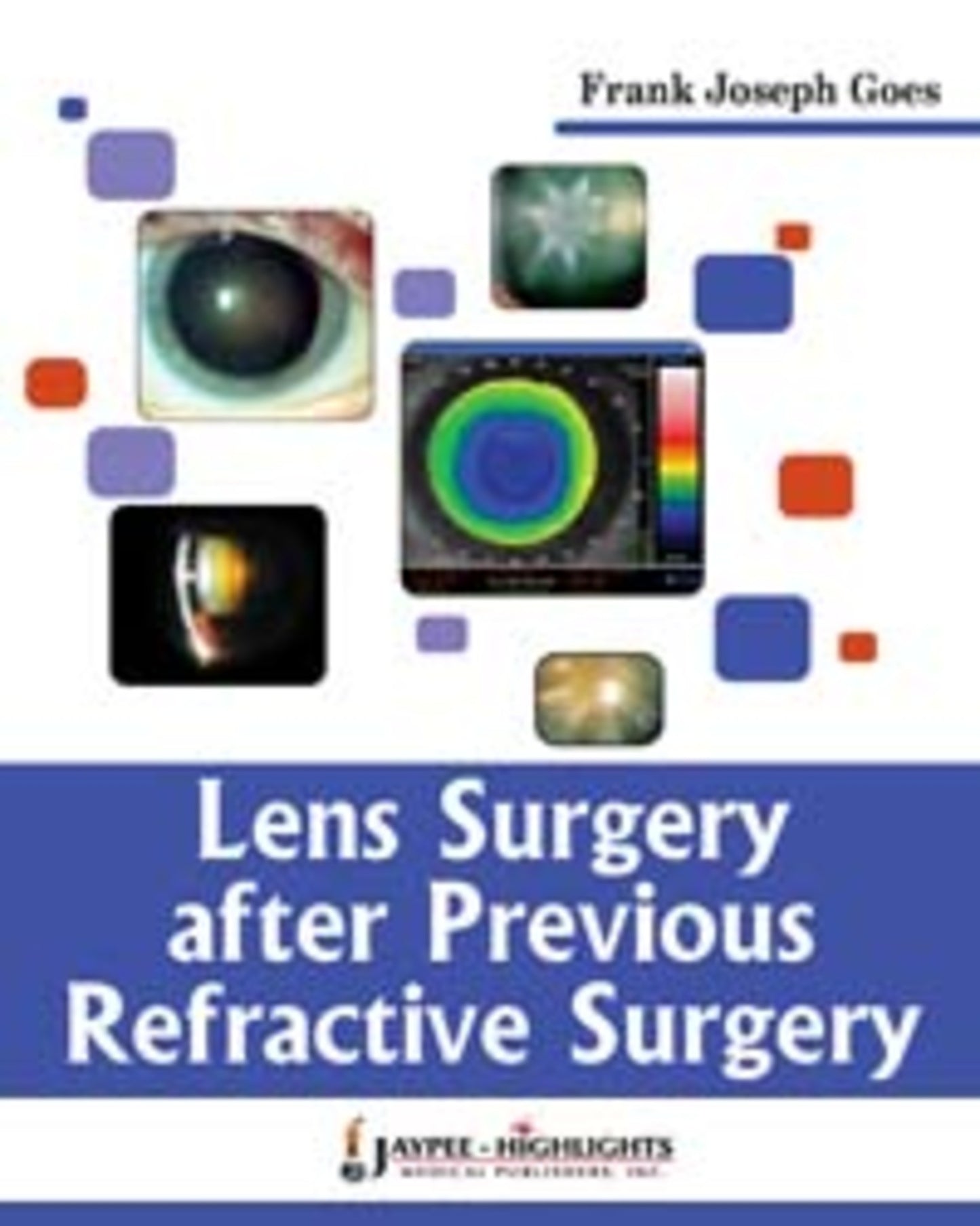 Lens Surgery After Previous Refractive Surgery