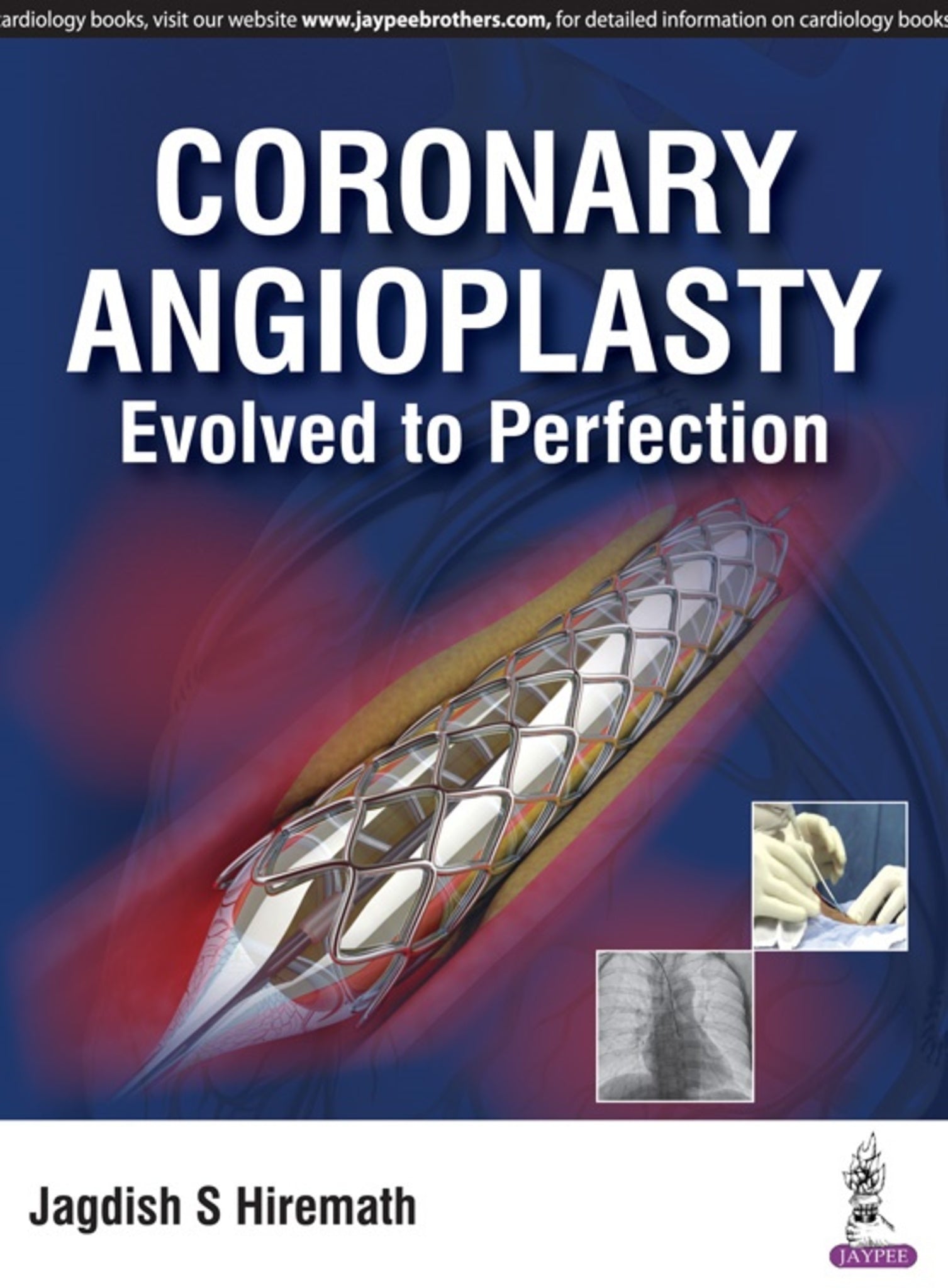 Coronary Angioplasty