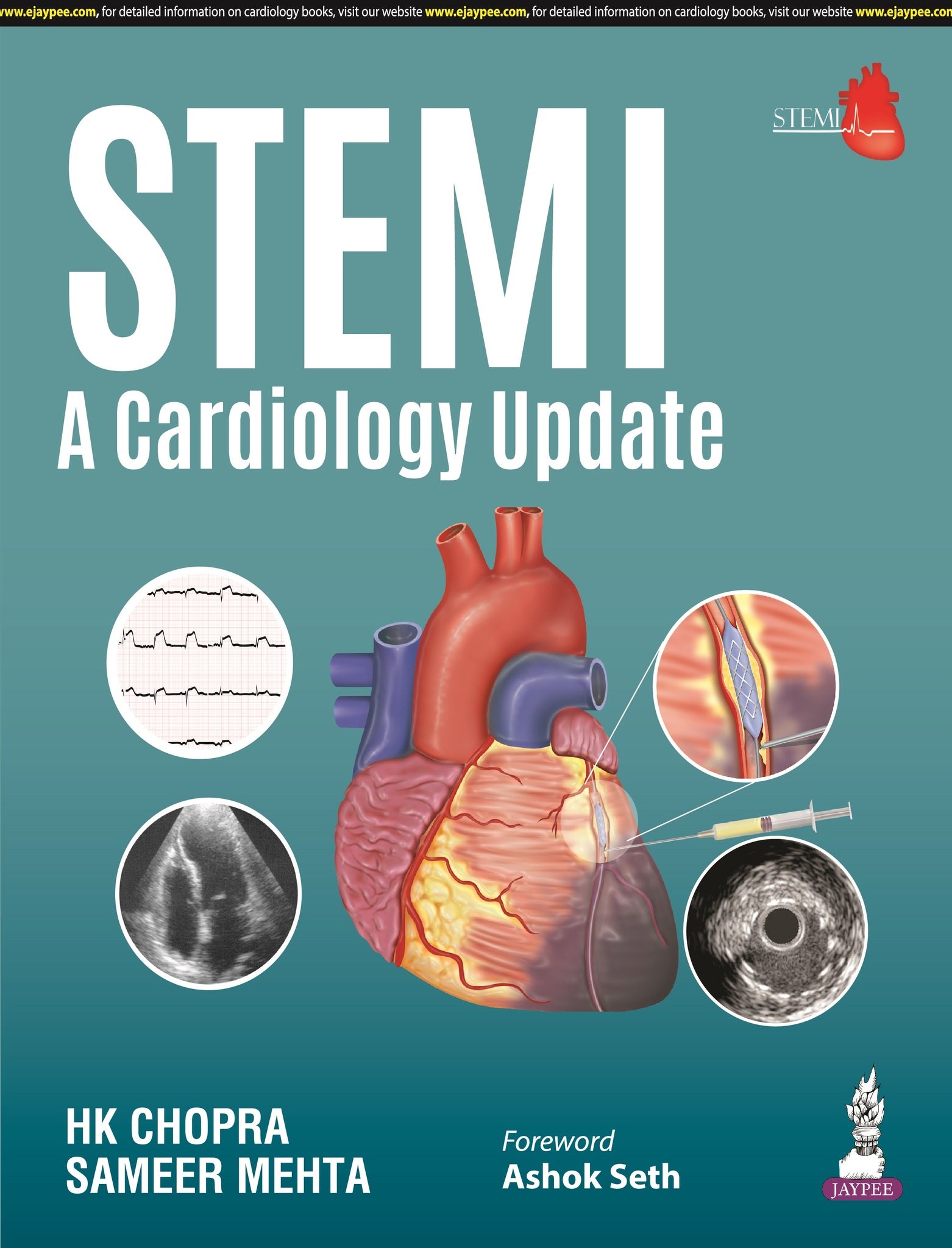 STEMI: A Cardiology Update