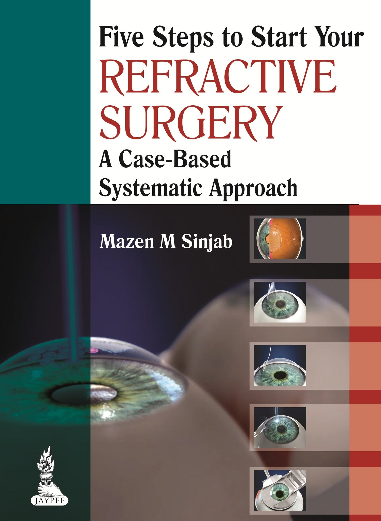 Five Steps to Start Your Refractive Surgery
