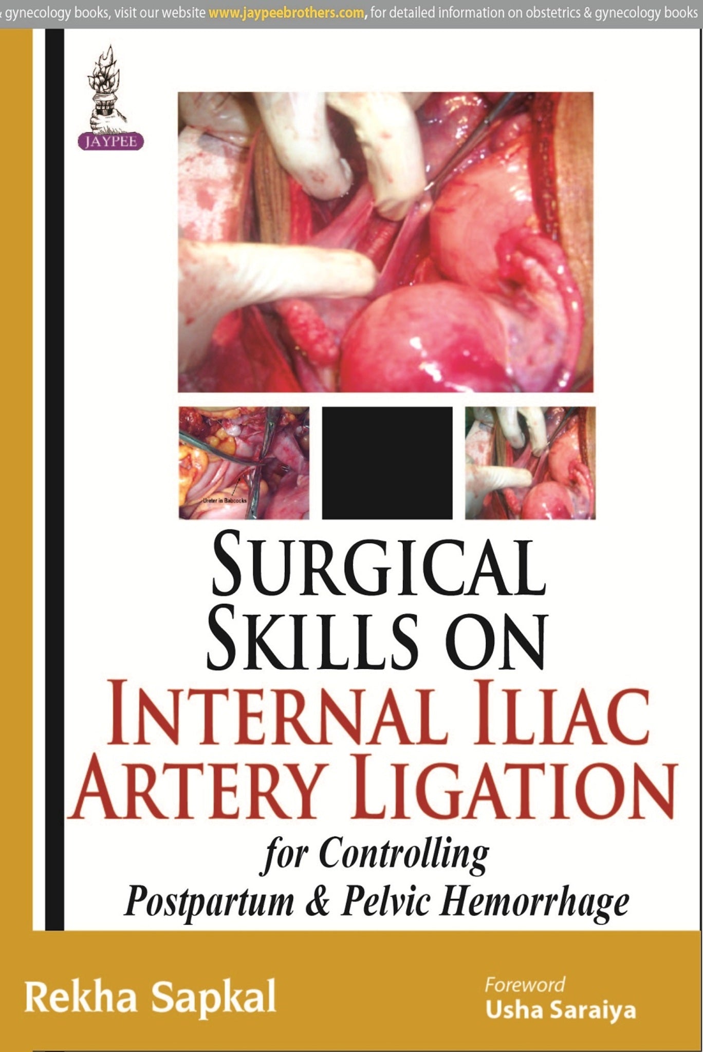 Surgical Skills on Internal Iliac Artery Ligation for Controlling  Postpartum and Pelvic Hemorrhage