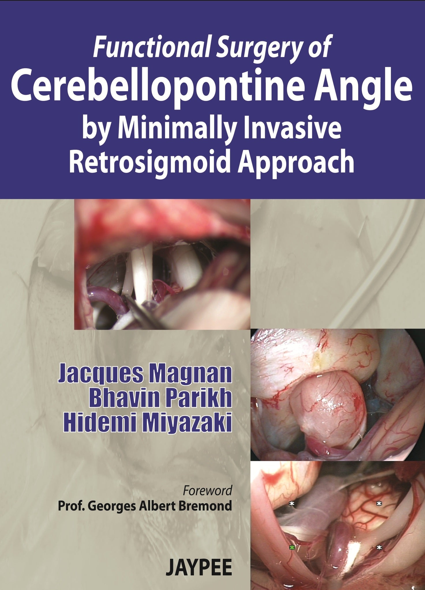 Functional Surgery of Cerebellopontine Angle by Minimally Invasive Retrosigmoid Approach