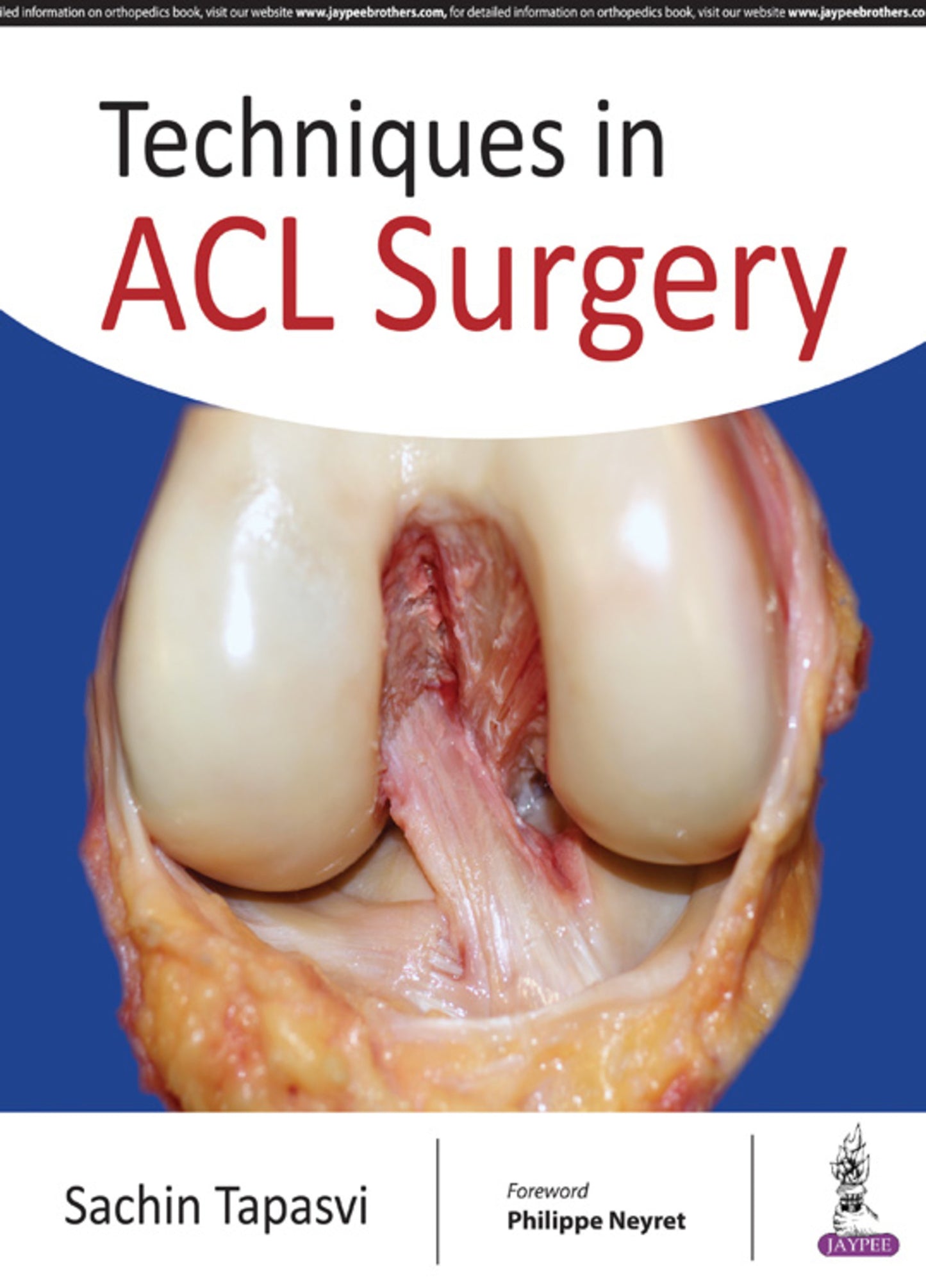 Techniques in ACL Surgery