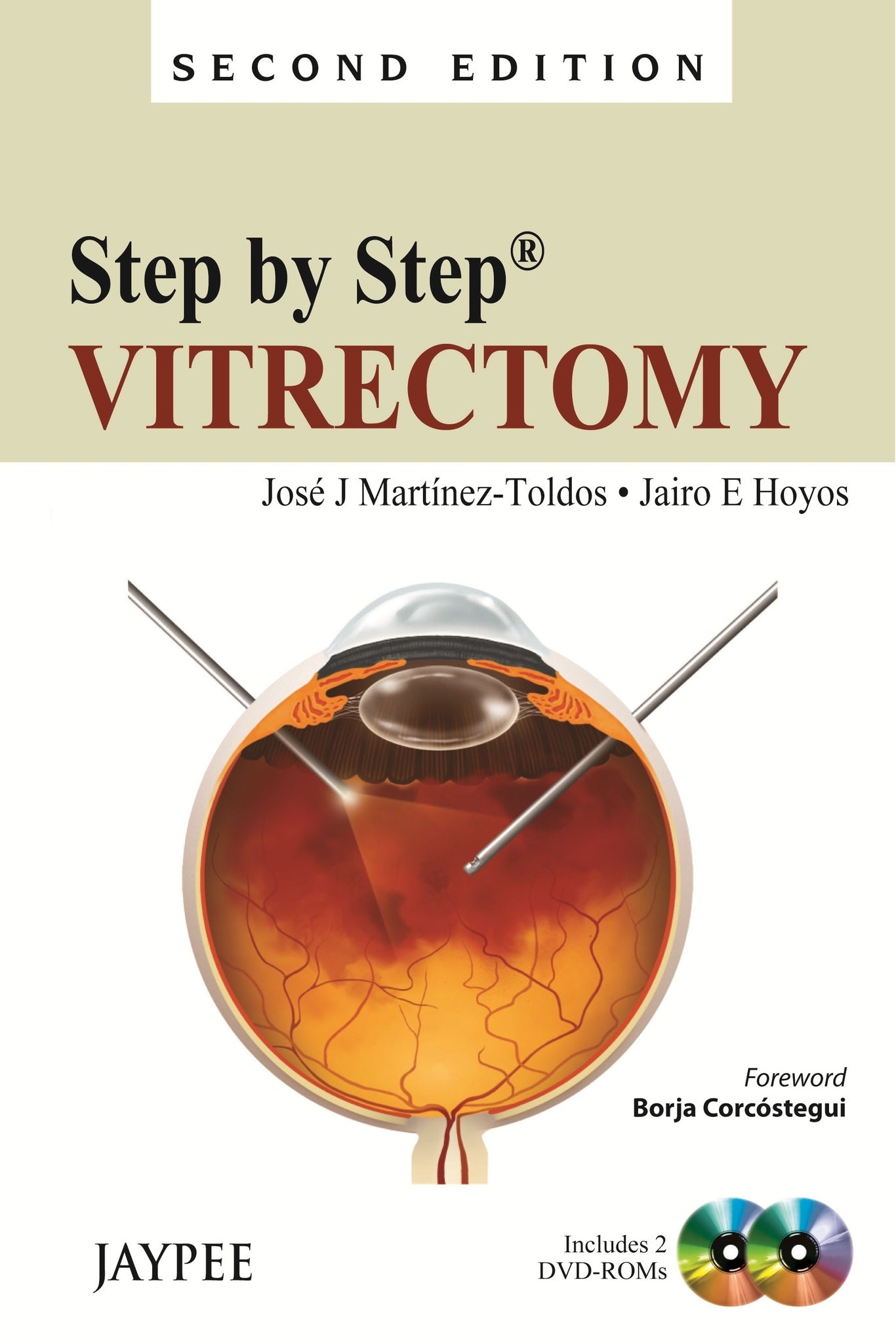 Step by Step: Vitrectomy