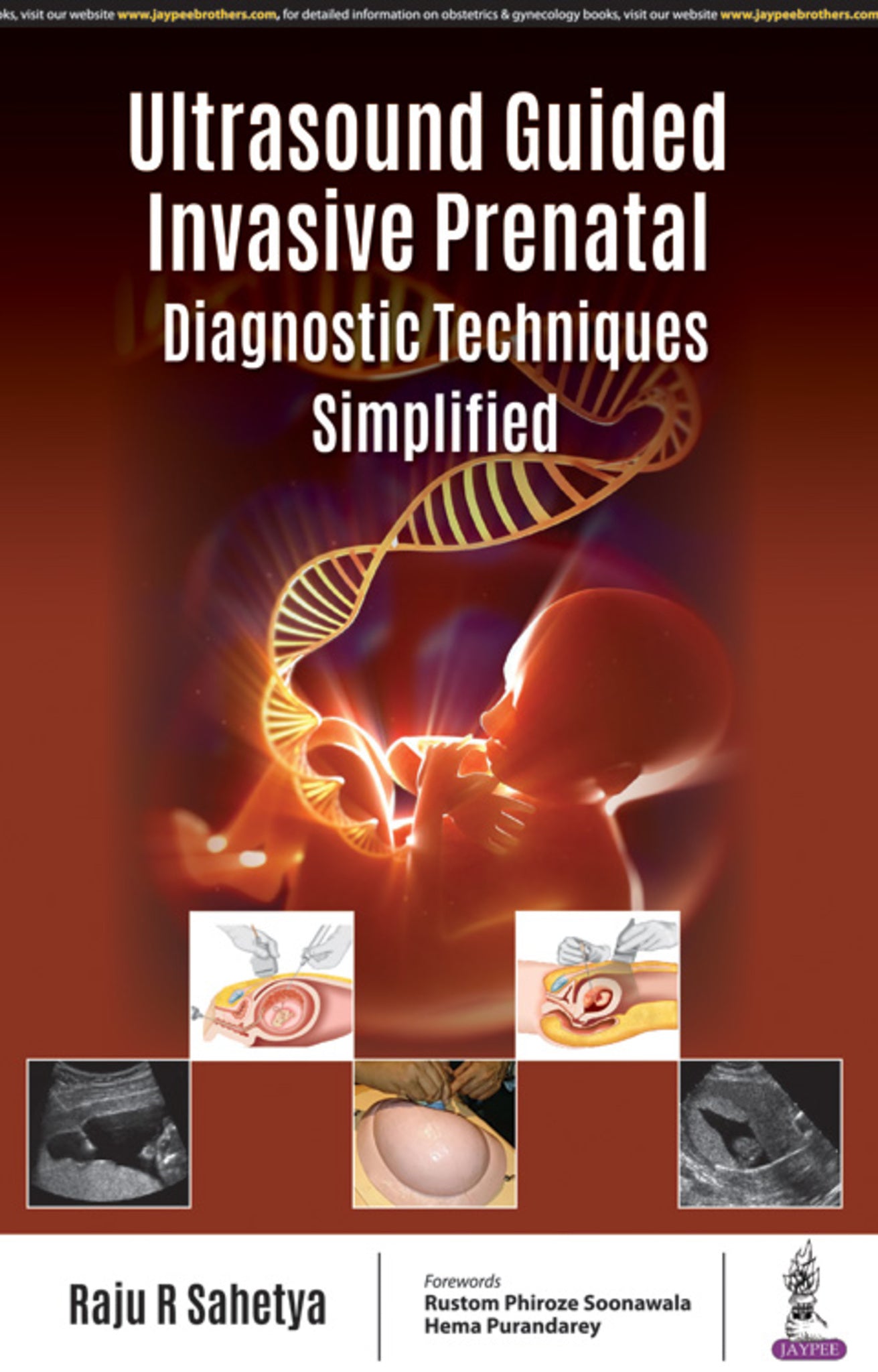 Ultrasound Guided Invasive Prenatal Diagnostic Techniques Simplified