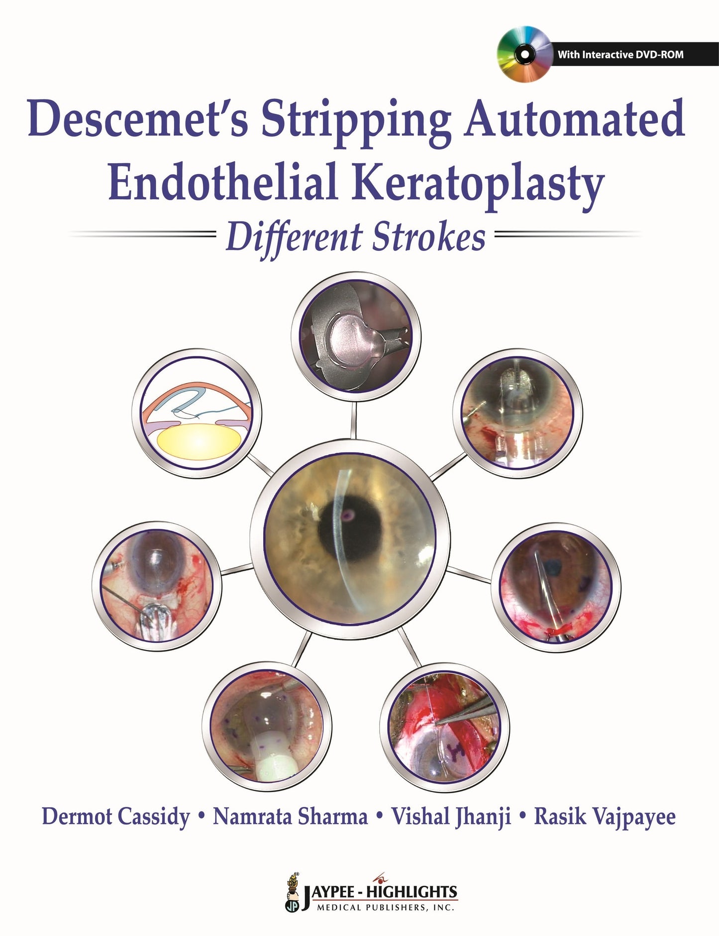 Descemet's Stripping Automated Endothelial Keratoplasty: Different Strokes