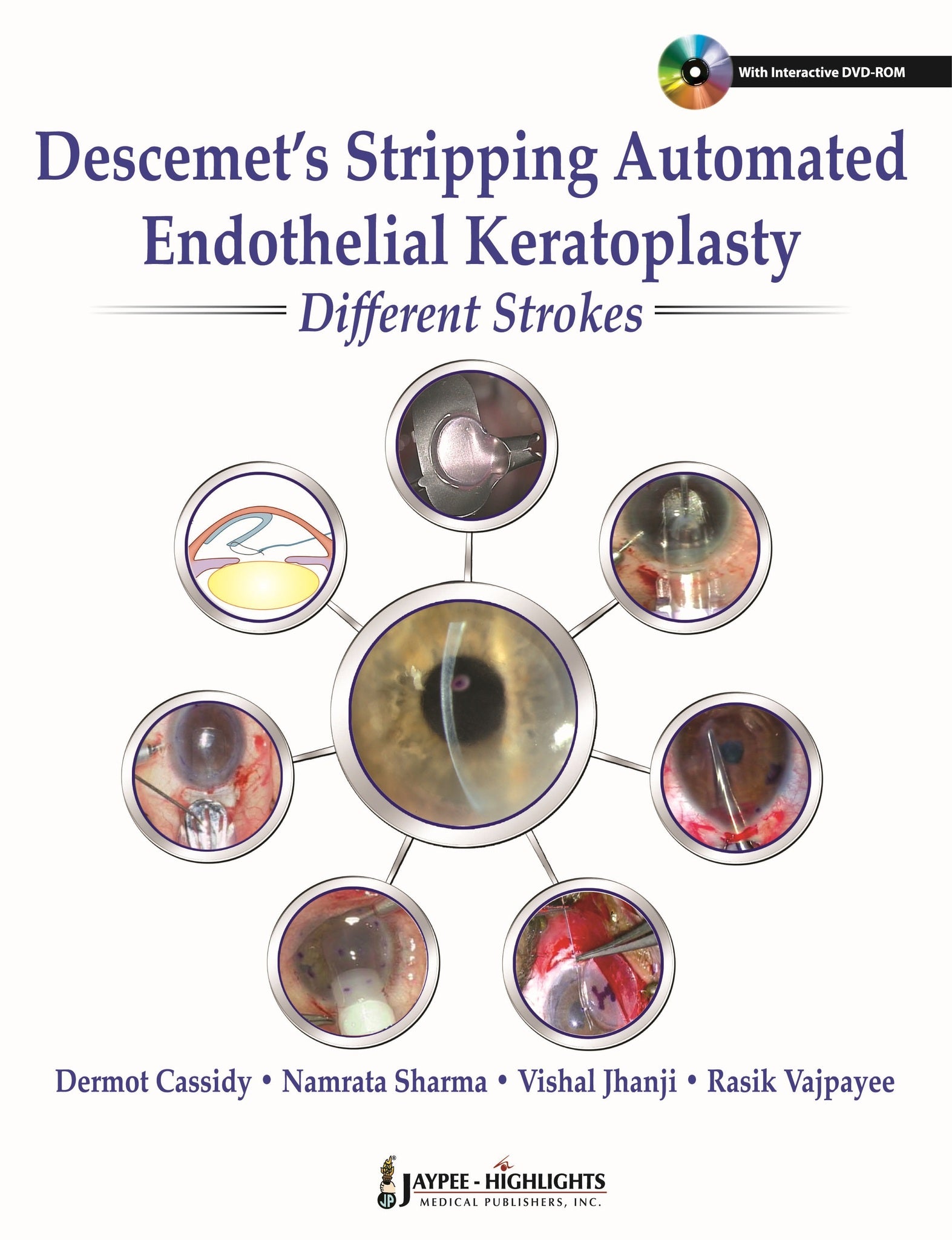 Descemet's Stripping Automated Endothelial Keratoplasty: Different Strokes