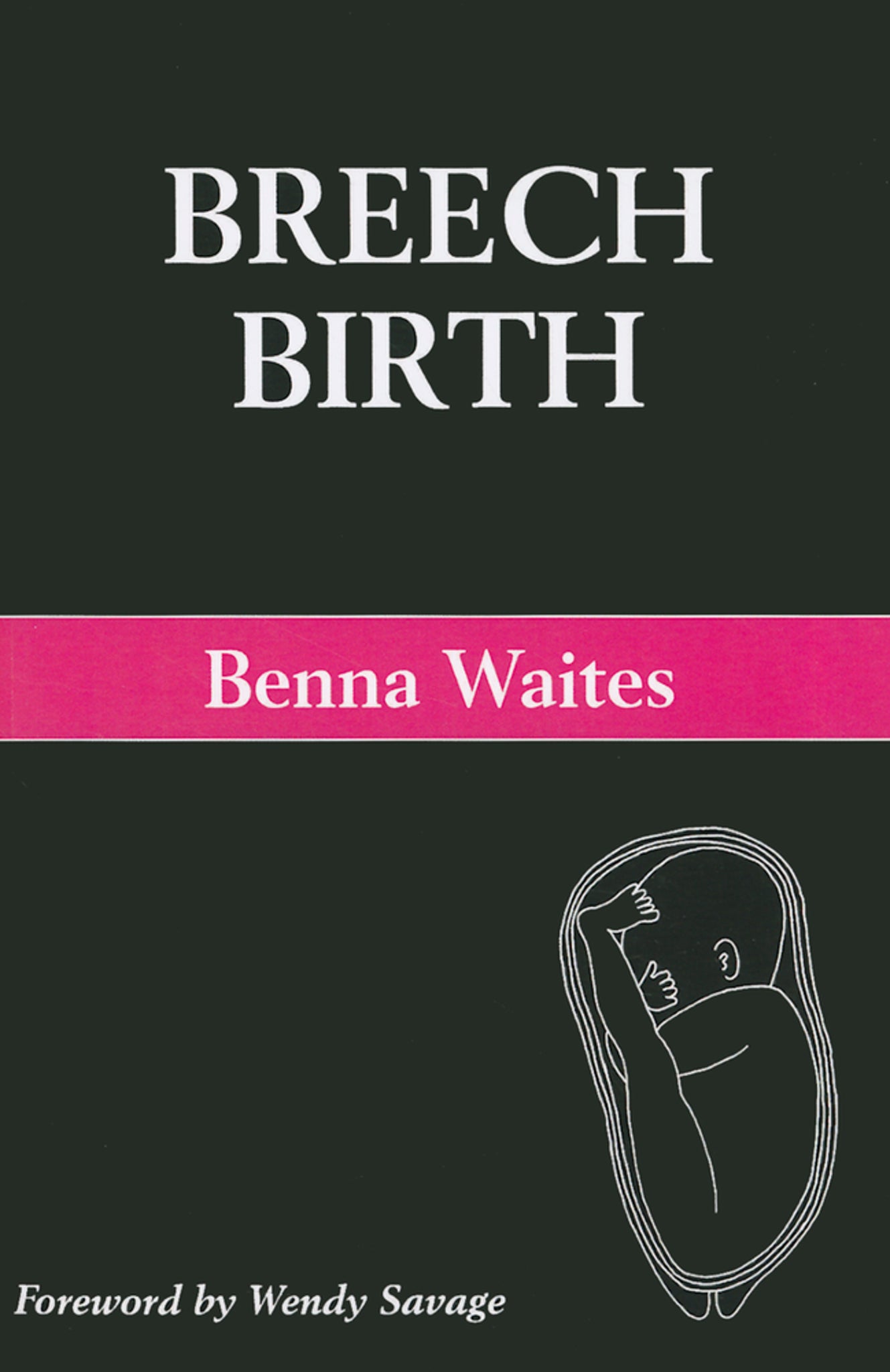 Breech Birth